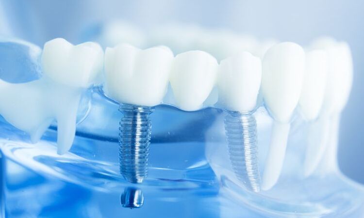 Guida sugli impianti dentali